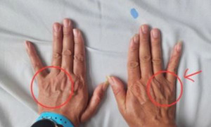 Tê ngón tay út tưởng chuyện nhỏ, người đàn ông suýt teo cả bàn tay