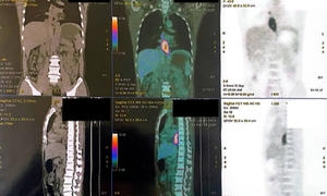 Nuốt nghẹn, sụt 5 kg, đi khám phát hiện mắc hai loại ung thư 