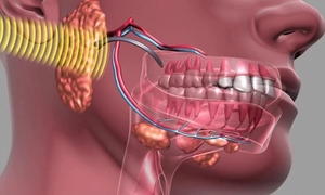 Bệnh u xương hàm nguy hiểm ra sao?