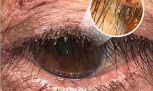 Phát hiện rận mu ký sinh dày đặc trên lông mi người phụ nữ ở Nghệ An