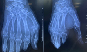  8 giờ vi phẫu nghẹt thở nối lại 4 ngón tay đứt lìa cho người đàn ông