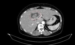 Vàng da tưởng sỏi mật, đi khám phát hiện cùng lúc hai ung thư 