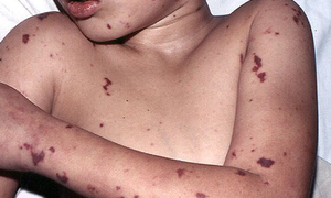 Cảnh báo bệnh não mô cầu ở trẻ: Dễ nhầm cảm cúm, nguy cơ tử vong cao