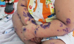 Gần 3.000 trẻ mắc chân tay miệng trong 2 tháng, 3 dấu hiệu cần đưa con đi viện