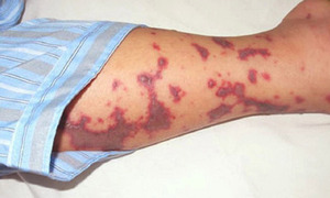 9 bệnh truyền nhiễm nào Bộ Y tế đề xuất phải cách ly y tế?