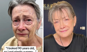 Cụ bà trông như 90 tuổi trẻ hóa kỳ diệu sau phẫu thuật căng da