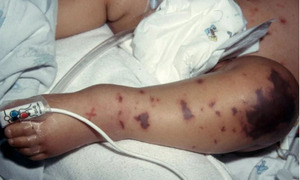 Liên tiếp ghi nhận ca mắc não mô cầu, nhận diện sớm dấu hiệu điển hình