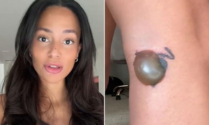 KOL hoảng sợ 'cầu cứu' khi gặp biến chứng 'kinh khủng' sau xóa hình xăm