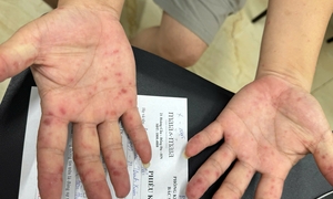 Số ca tay chân miệng tăng mạnh, cảnh báo nguồn lây từ tay nắm cửa, đồ chơi