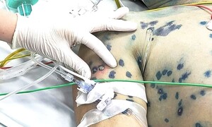 Khuyến cáo người trưởng thành không chủ quan với thuỷ đậu