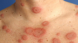 Căn bệnh nguy hiểm chỉ 10% được chẩn đoán sớm, có người vài năm mới phát hiện