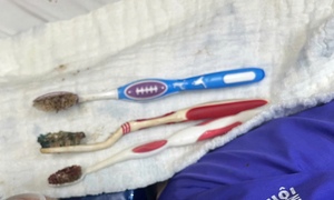 Nuốt liền 3 bàn chải đánh răng, nam thanh niên được cứu kịp thời