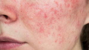 Hiểm họa khi tự ý lạm dụng thuốc, mỹ phẩm chứa corticoid