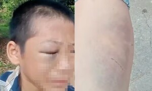 Bé trai 11 tuổi nghi bị bố và mẹ kế bạo hành ở Nghệ An: Công an vào cuộc