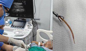 Đau bụng suốt 10 ngày, bất ngờ phát hiện tăm tre đâm thủng đại tràng