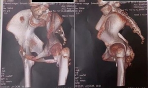 Lần theo dấu vết bất thường, bác sĩ phát hiện bệnh 'người hóa đá' hiếm gặp