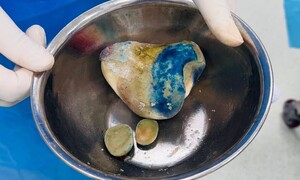 Cụ ông 86 tuổi mang khối sỏi bàng quang gần nửa kg