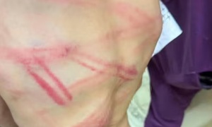 Bé trai 9 tuổi nhập viện với nhiều vết bầm tím, cha đến công an tự thú