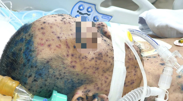 Lây thủy đậu từ con, bố 36 tuổi nguy kịch vì biến chứng nặng