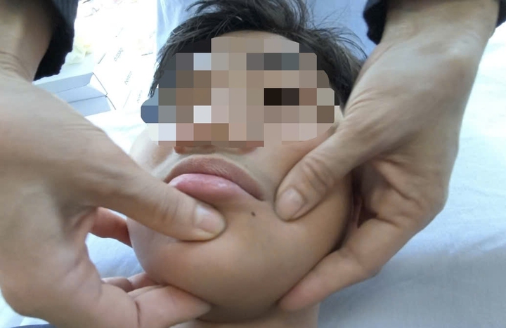 Liệt dây thần kinh số 7 do rét đậm