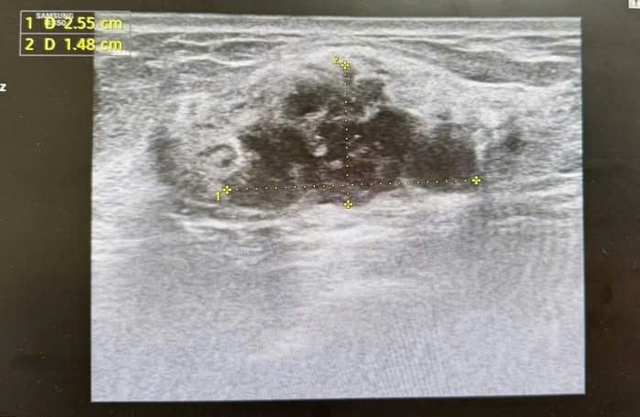 Phát hiện ung thư khi đi khám sức khoẻ định kỳ