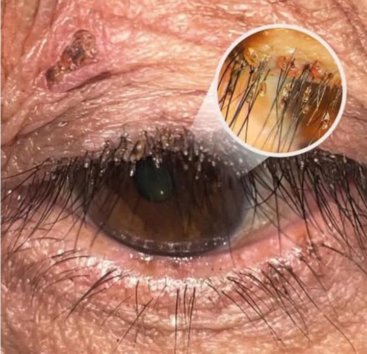 Phát hiện rận mu ký sinh dày đặc trên lông mi người phụ nữ ở Nghệ An