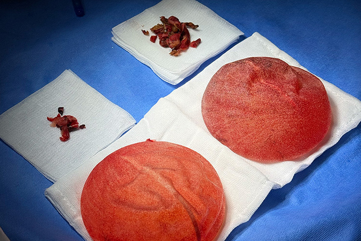 Nguyên nhân gây vỡ túi ngực sớm