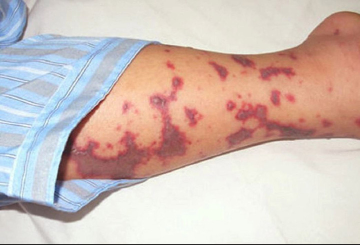 9 bệnh truyền nhiễm nào Bộ Y tế đề xuất phải cách ly y tế?