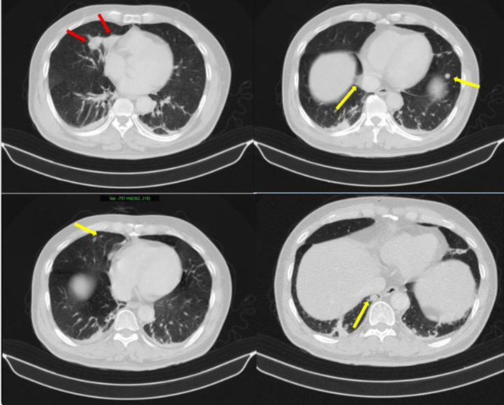 Người đàn ông phát hiện mắc hai bệnh ung thư cùng lúc