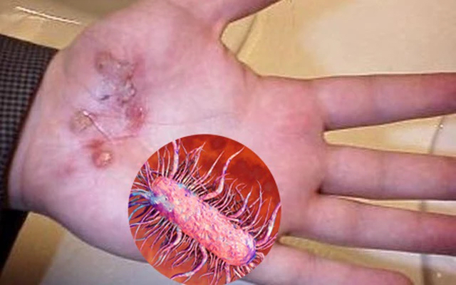 Suýt mất mạng do vi khuẩn "ăn thịt người" tấn công