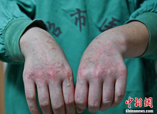 Bên trong khu cách ly dịch corona: Nhân viên y tế ngủ 3 tiếng, không có thời gian đi vệ sinh - 3