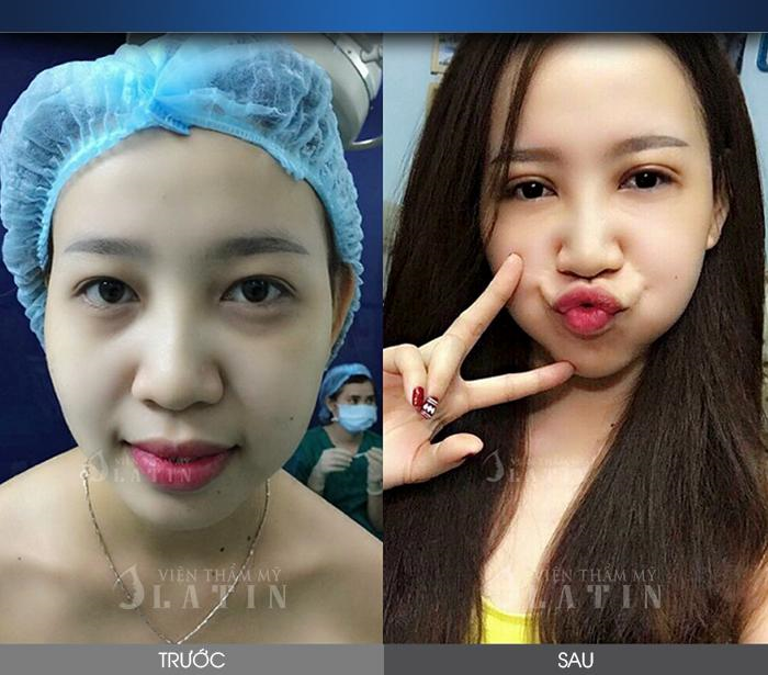 Làm đẹp an toàn, chất lượng tại Viện thẩm mỹ Latin - 3