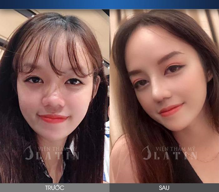 Làm đẹp an toàn, chất lượng tại Viện thẩm mỹ Latin - 2