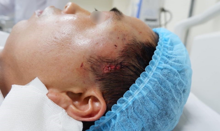 Độn thái dương ở mỹ viện không phép, người đàn ông nhập viện cấp cứu - 1