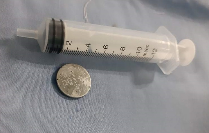 Nuốt pin, bé 16 tháng tuổi nhập viện cấp cứu - 1