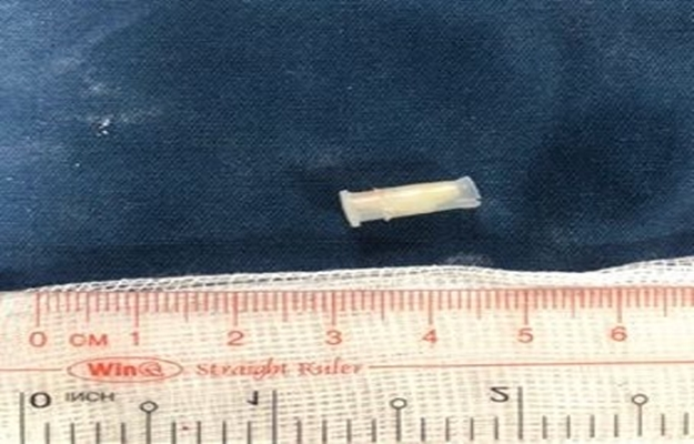 Bé trai 3 tuổi nuốt nguyên chiếc còi đồ chơi, thở tiếng kèn kêu - 1