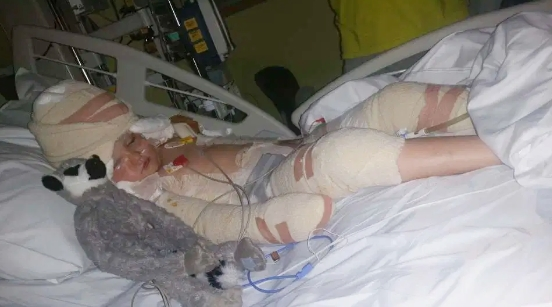 Bé gái 5 tuổi bị bỏng toàn thân kiên cường trải qua hơn 100 lần phẫu thuật - 1