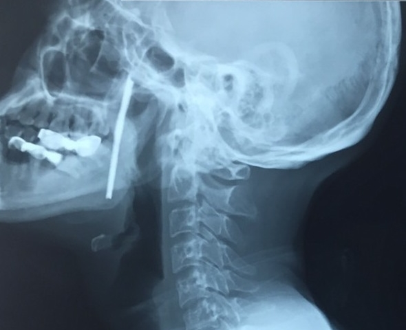 Cứu người đàn ông bị thanh sắt đâm xuyên cổ - 1