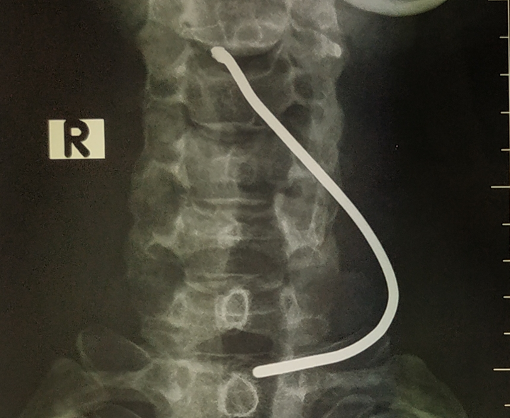 Nổ lốp xe tải, người đàn ông bị thanh sắt bắn vào cổ - 1
