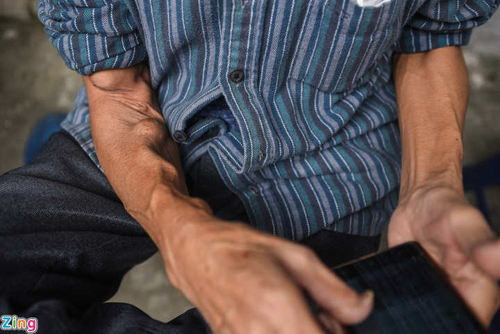 Cuộc sống của những bệnh nhân xóm chạy thận Bạch Mai giữa mùa dịch Covid-19 - 3