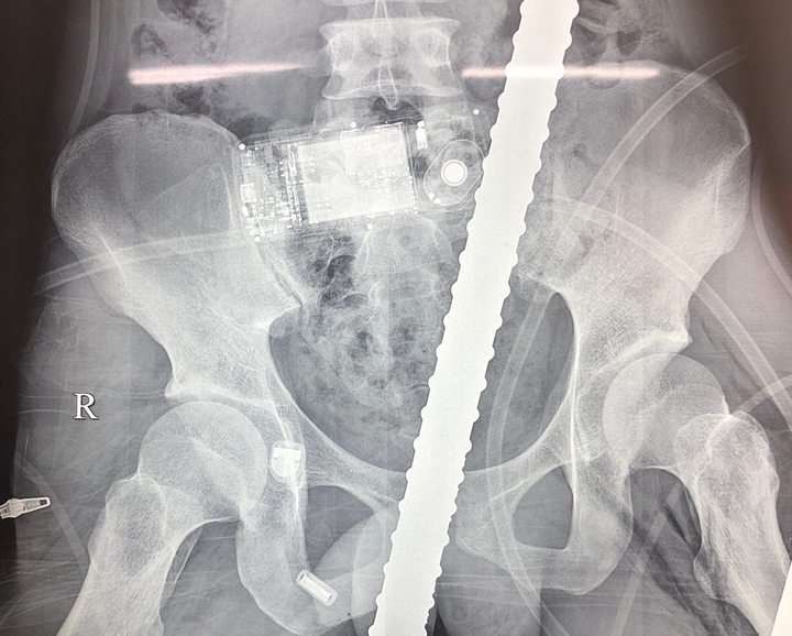 Cứu sống thanh niên bị 2 thanh sắt đâm xuyên ngực nguy kịch - 1