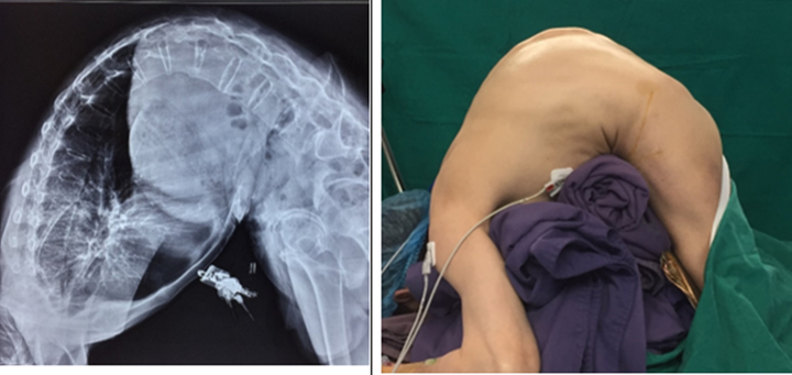 Nắn chỉnh biến dạng cột sống cho người đàn ông gù 10 năm không thể nằm ngửa - 1