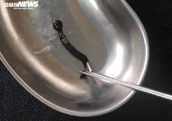 Con đỉa dài 4cm sống ký sinh cả tháng trời trong mũi bé gái 11 tuổi - 1