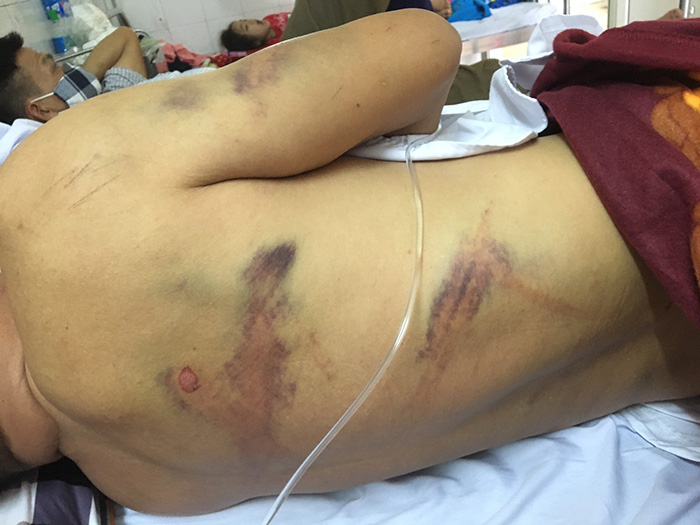 Thầy giáo dạy lái xe ở Hải Dương bị 2 kẻ côn đồ đánh gãy 4 xương sườn - 2