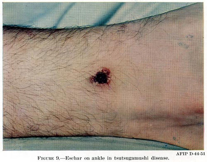 Bác sĩ cảnh báo nguy hiểm từ vết côn trùng đốt - 1