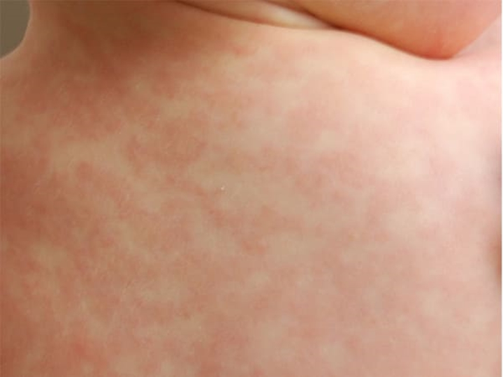 7 căn bệnh thường gặp vào mùa hè và cách phòng ngừa - 5