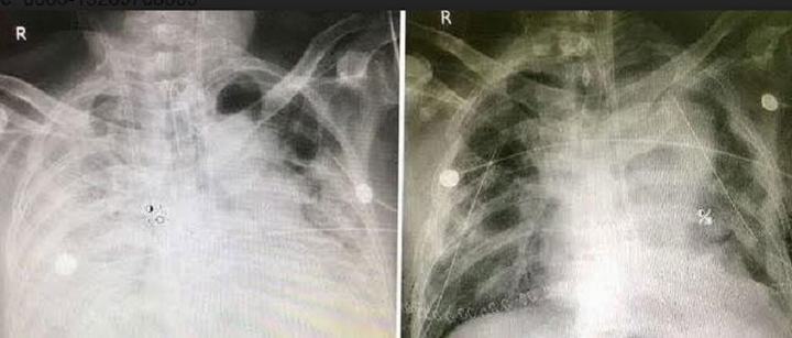 Ba ca COVID-19 nặng của Trung Quốc 'thoát cửa tử' nhờ ghép phổi - 3