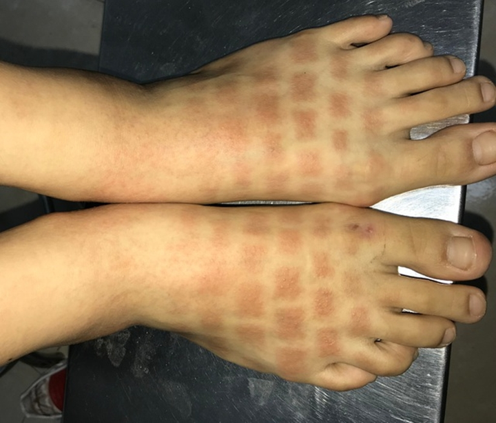 Đi tắm biển, cô gái bị bỏng nắng phải nhập viện khẩn cấp - 1