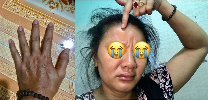 Diễn viên 'Bi, đừng sợ' mặt sưng, tay sạm đen, khó thở vì ngộ độc hải sản - 1