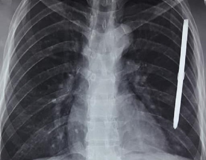 Cắt cỏ bằng máy, người đàn ông bị tuốc nơ vít cắm sâu vào phổi - 1